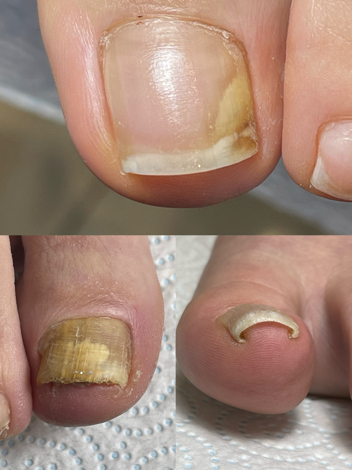 Onycholysis, Nail Fungus, Ingrown nails course 24.01