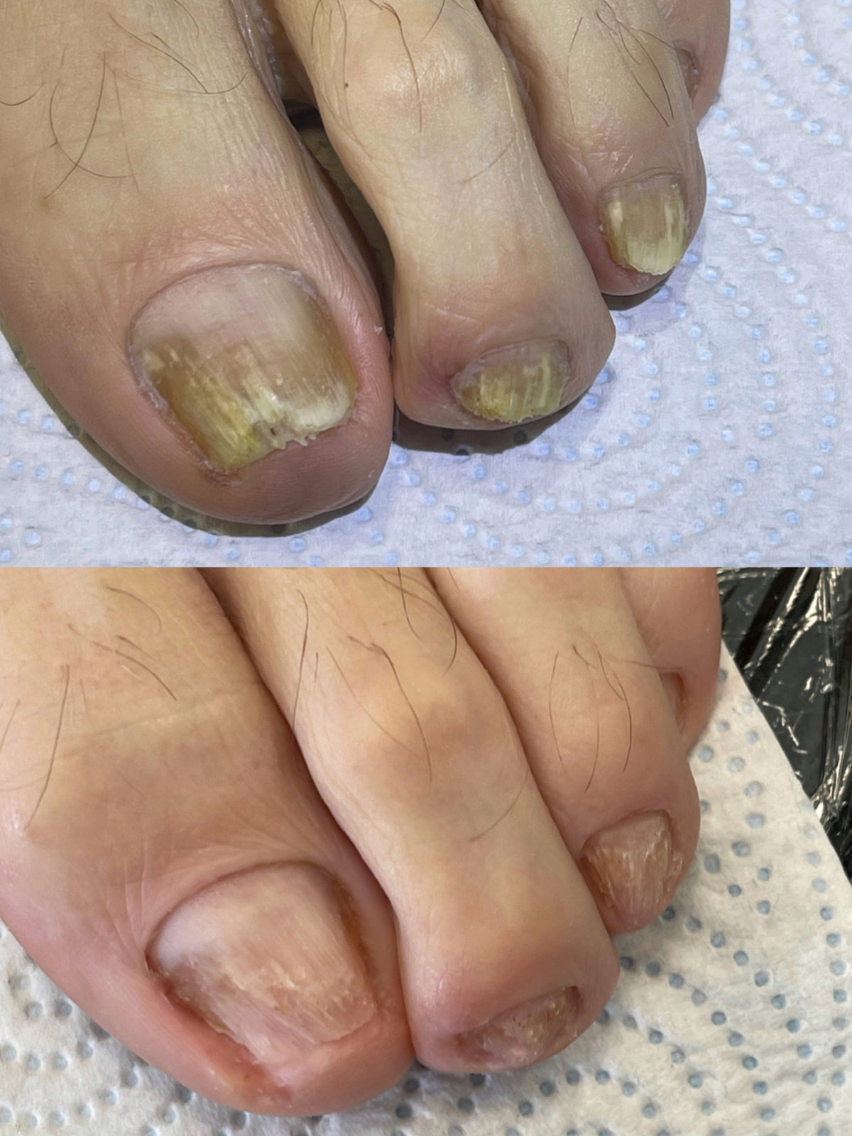 Onycholysis, Nail Fungus, Ingrown nails course 24.01