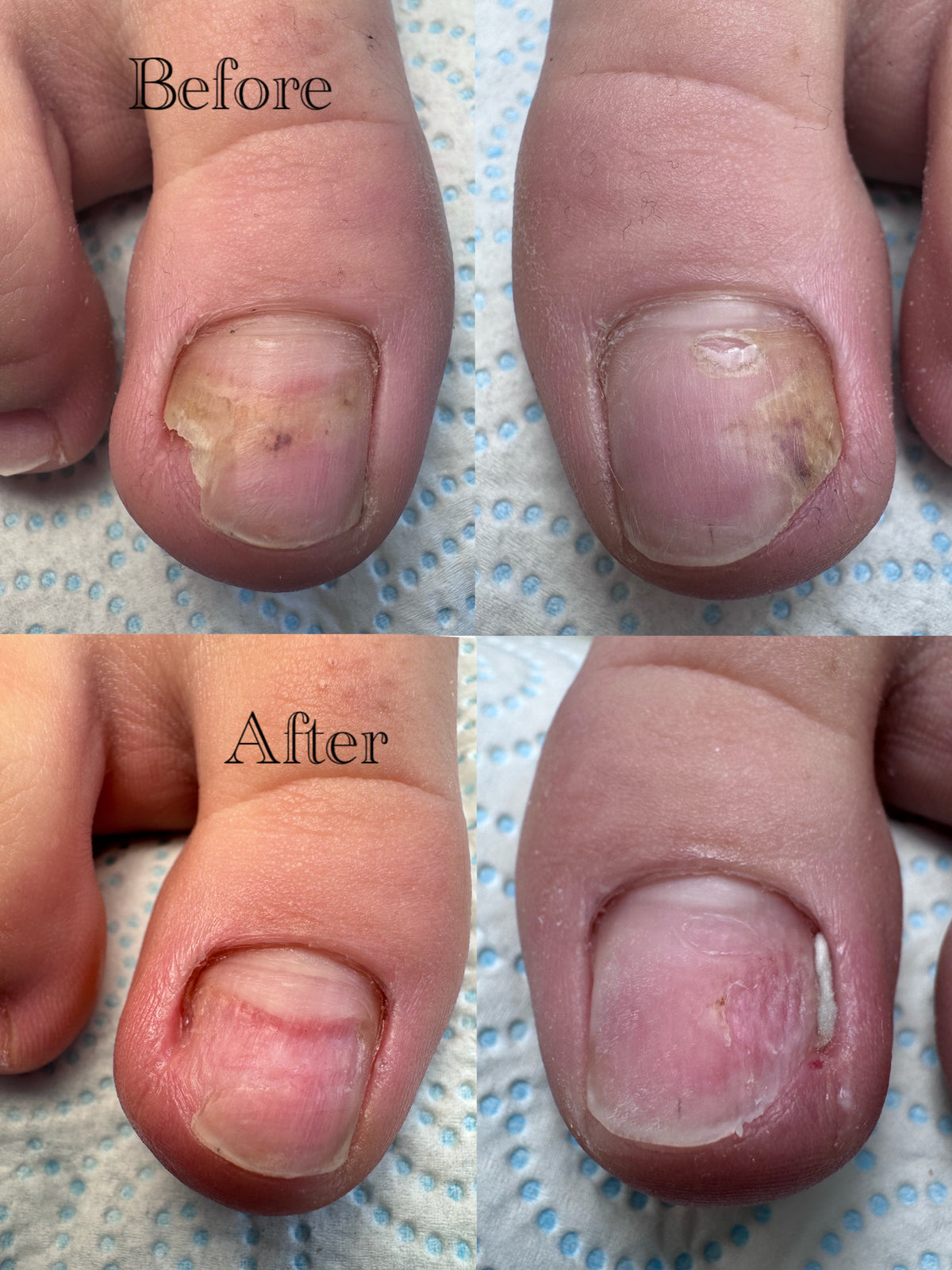 Onycholysis, Nail Fungus, Ingrown nails course 24.01